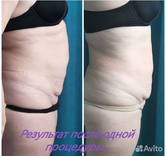 Жиросжигающая процедура индиба