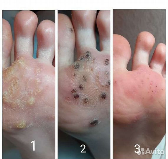 Коррекция вросшего ногтя Подолог