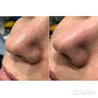 Чистка лица модель