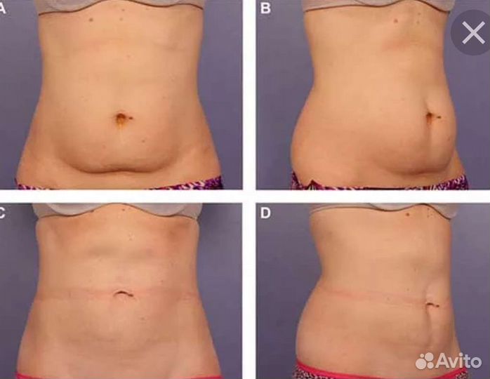 Липосакция похудение на Липсоникс или жиротоп