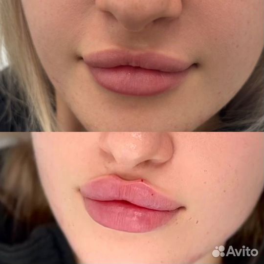 Модель на увеличение губ