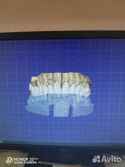 Зубной Техник, Съёмные протезы, Виниры, Керамика