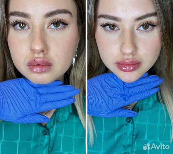 Увеличение губ/кп лица/ботокс обучение