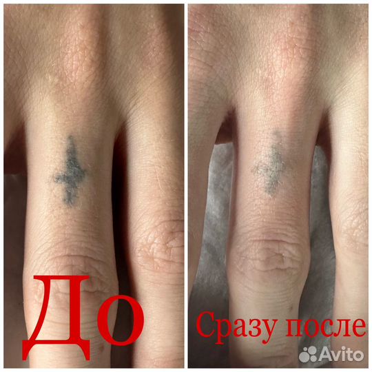 Лазерное удаление тату/татуажа/пм