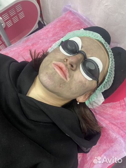 Карбоновый пилинг