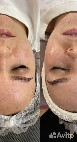 Карбокситерапия