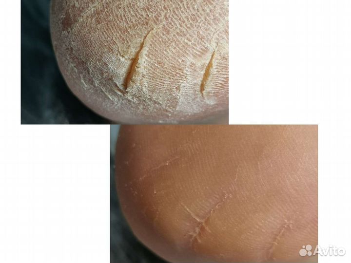 Подолог, вросший ноготь, грибок, зачистка