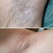 Депиляция Шугаринг, Красноярск