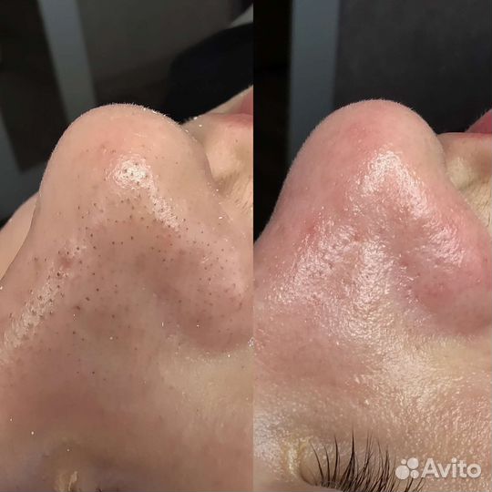 Пилинг лица молочной кислотой