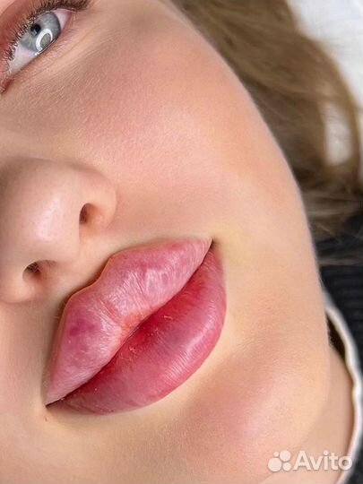 Увеличение губ