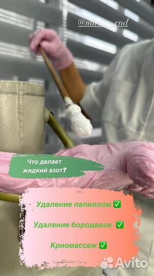 Удаление бородавок и папиллом Жидким Азотом