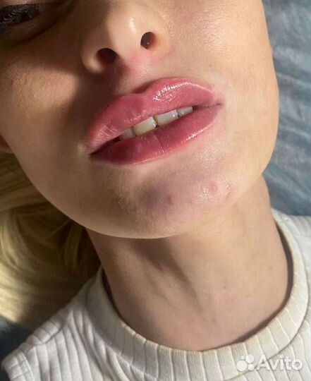 Увеличение губ