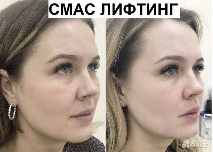 СМАС лифтинг для лица