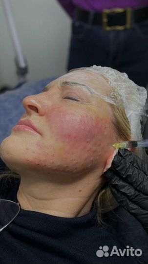 Коктейль монако мезотерапия биоревит липолитики