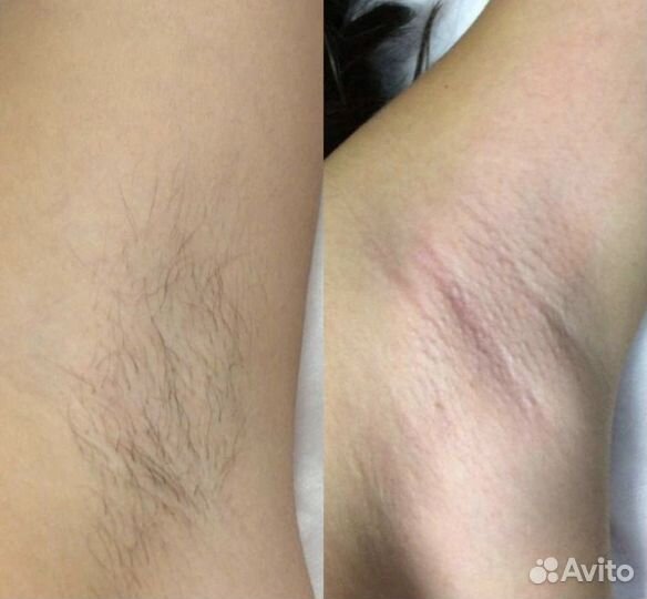 Шугаринг нужны модели для отработки скорости