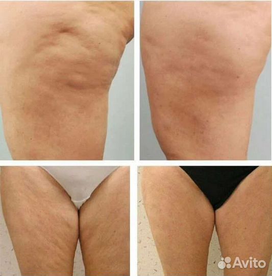 Набираю моделей на курс похудения