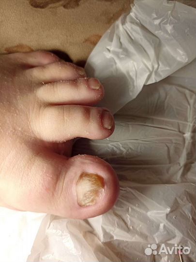 Педикюр подолог