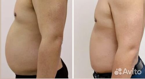 Липосакция, жиротоп и похудение Липосоникс