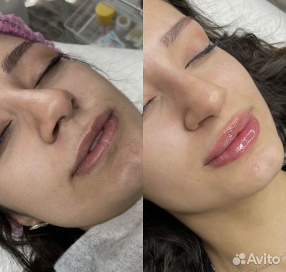 Увеличение губ