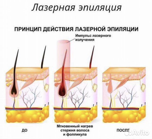 Лазерная эпиляция