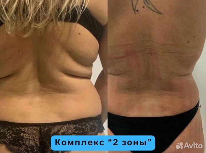 Коррекция фигуры / LPG массаж / Exilis