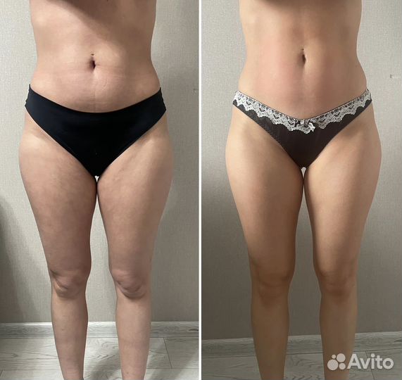 LPG массаж B-flexy