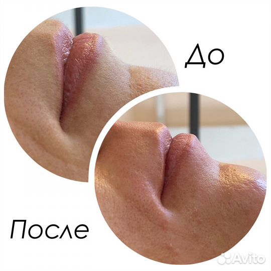 Депиляция воском шугаринг