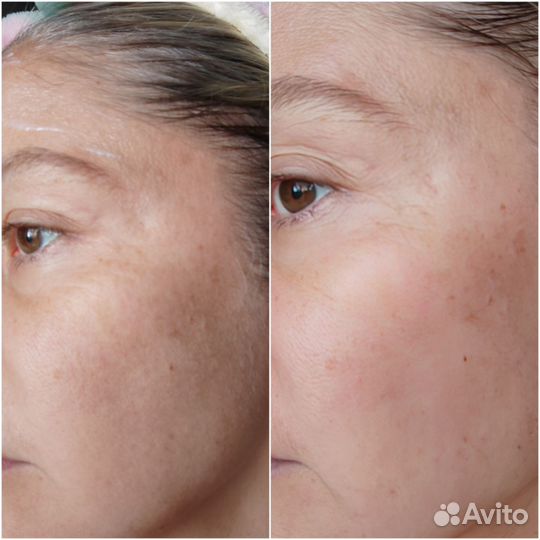 Пилинг Модильяни для лица