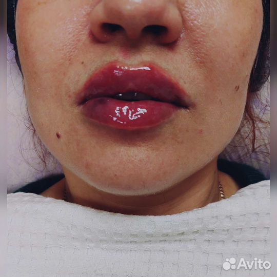 Увеличение губ