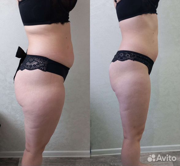 Антицеллюлитный массаж, аппаратный массаж. Южный