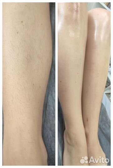 Депиляция воском