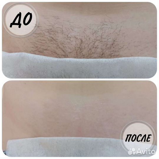 Депиляция, Шугаринг, Новая Охта