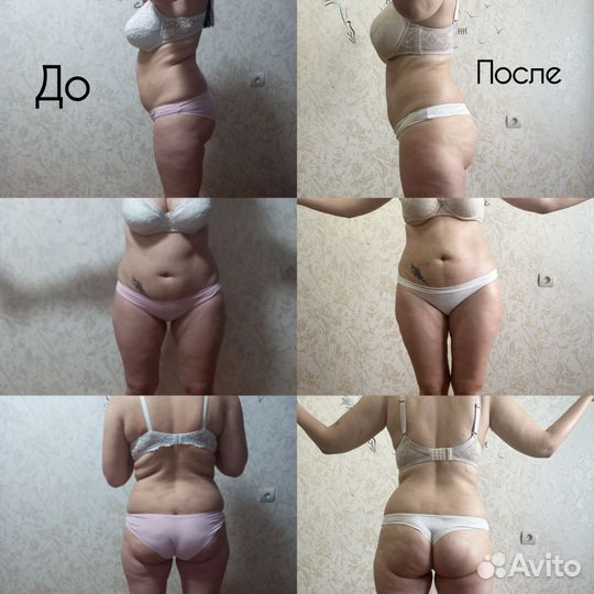 Антицеллюлитный массаж/Классический массаж