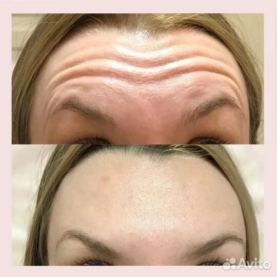 Ботулинотерапия