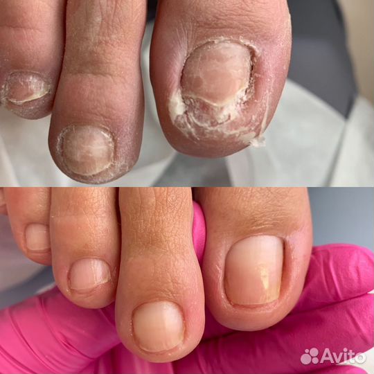 Медицинский педикюр