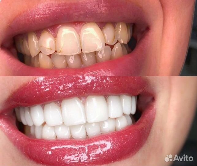 Виниры Керамические - без обточки