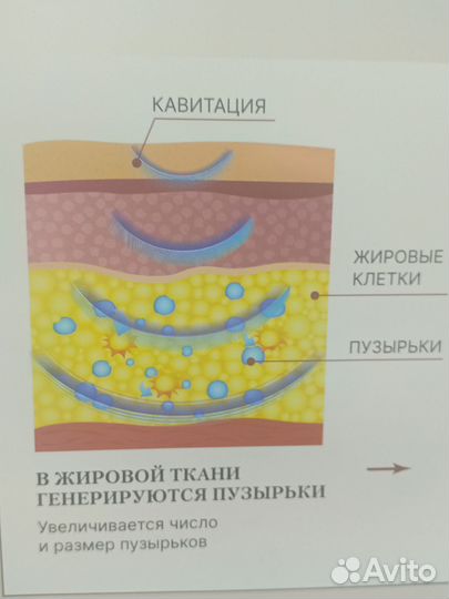 Кавитация вакуумная. Коррекция фигуры