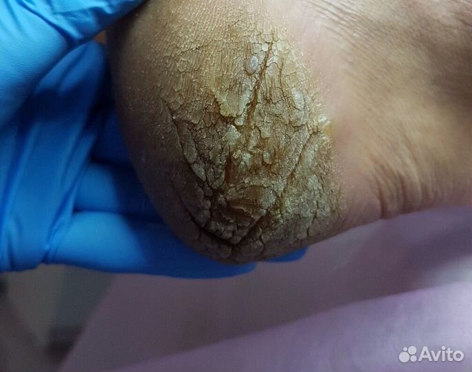 Педикюр любой сложности с подологическим уклоном