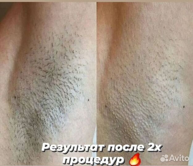 Лазерная эпиляция