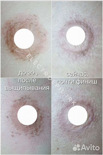 Электроэпиляция: глубокое бикини