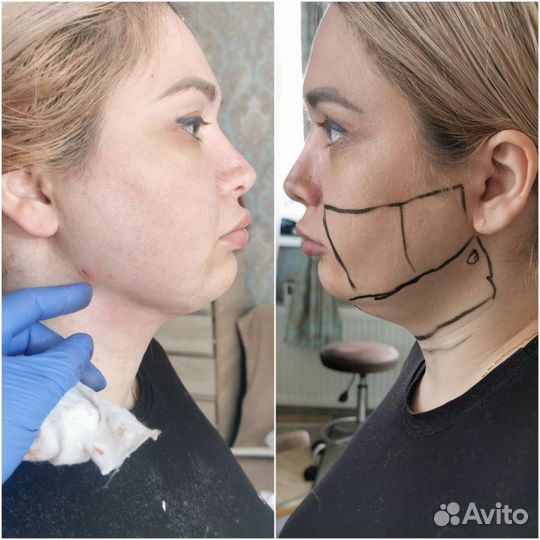 Липоредукция подбородка. Косметолог