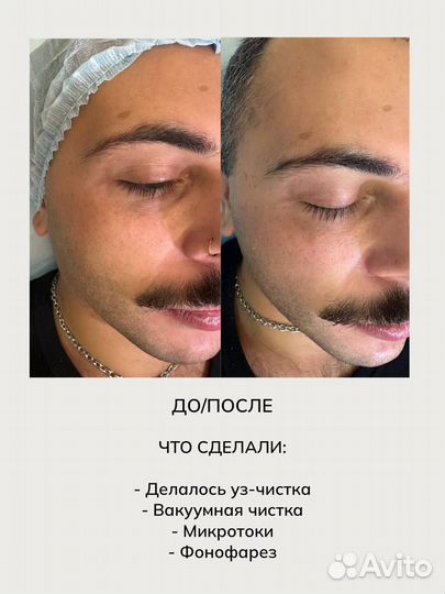 Косметолог Чистка лица Аппаратная косметология