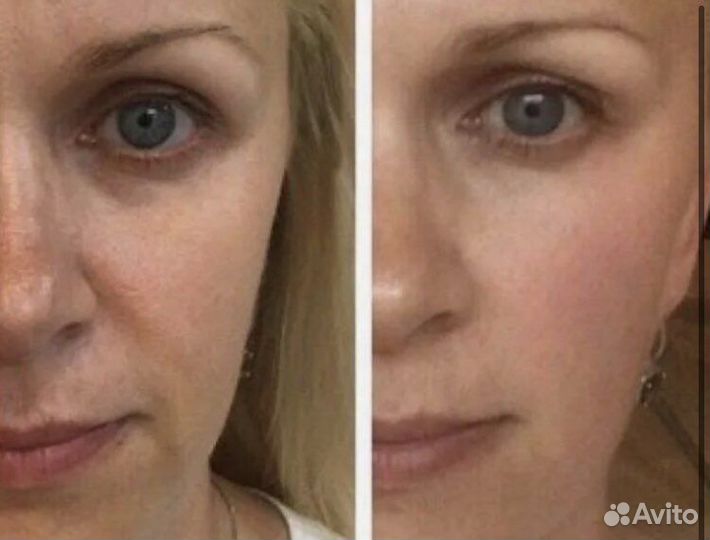 Rf лифтинг лица