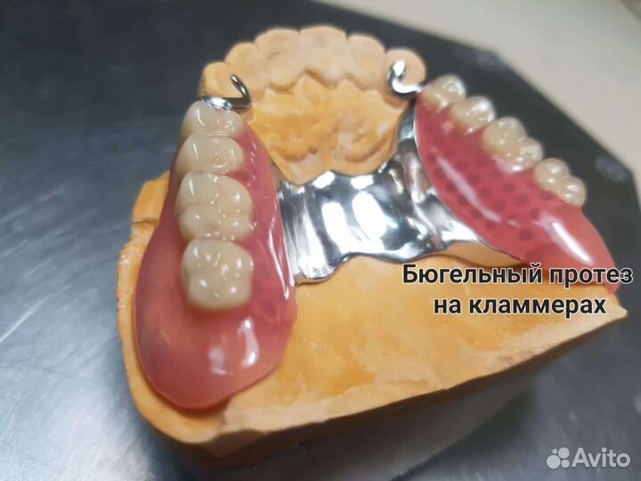 Изготовление съёмного протеза