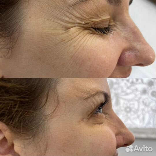 Смас лифтинг лица