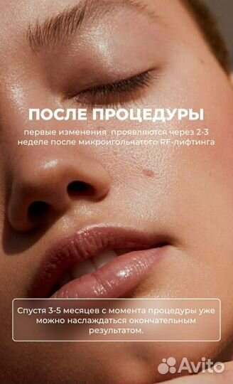 Микроигольчатый RF лифтинг