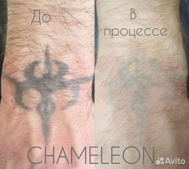 Удаление татуировок