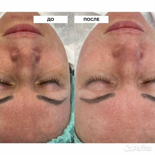 Пилинг Чистка лица Карбокситерапия Косметолог