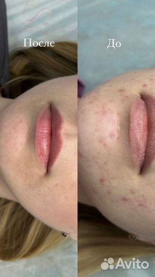 Чистка лица