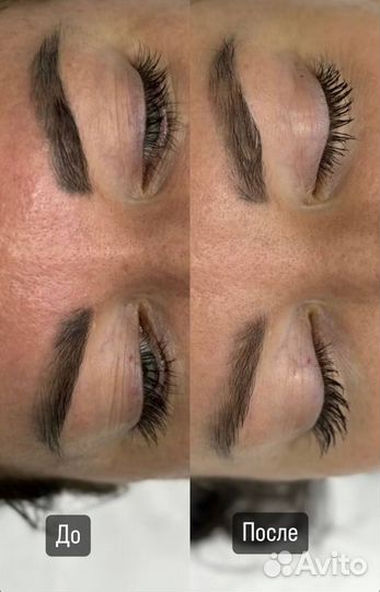 Удаление перманентного макияжа лазером